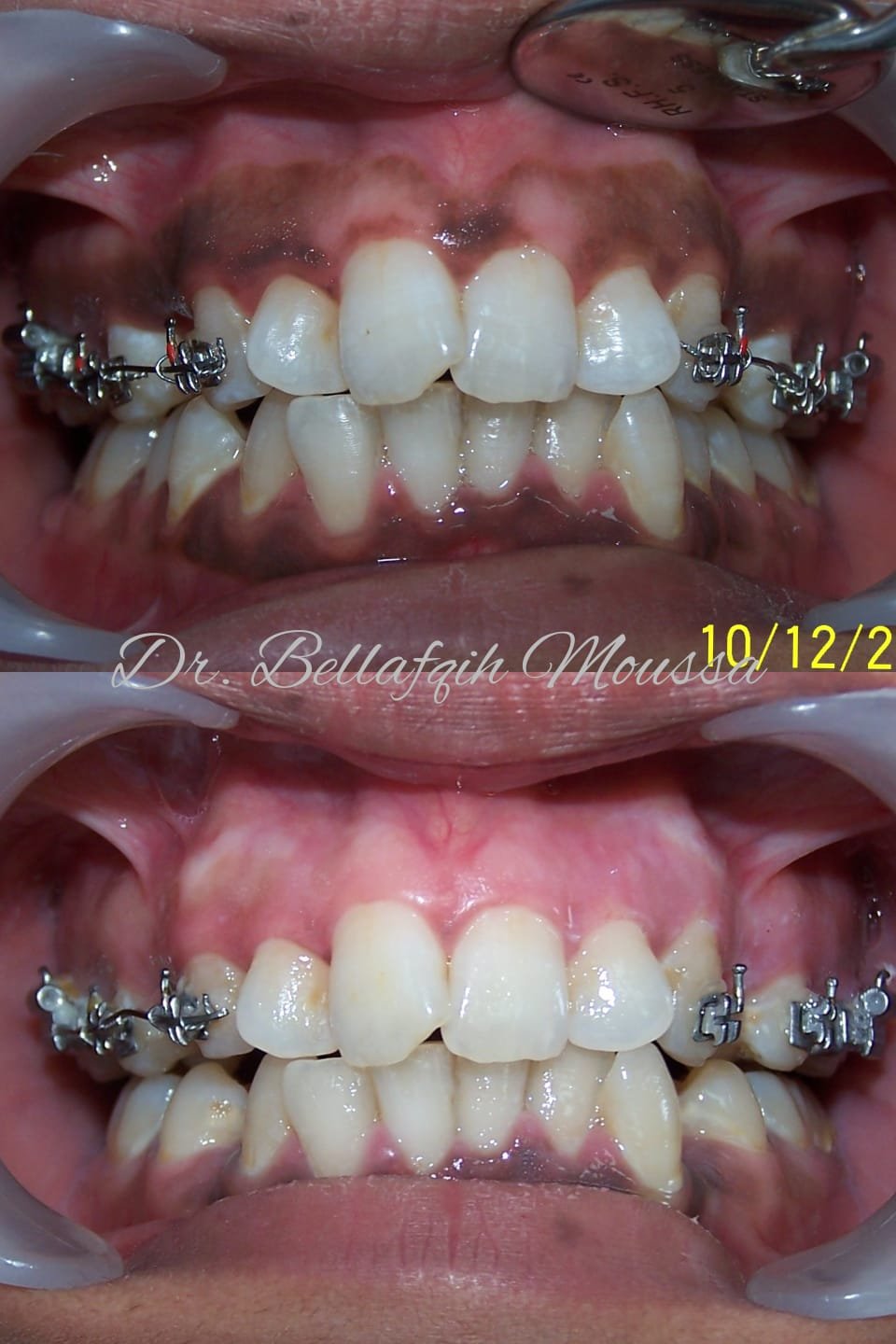 Dépigmentation gingivale — cas 2