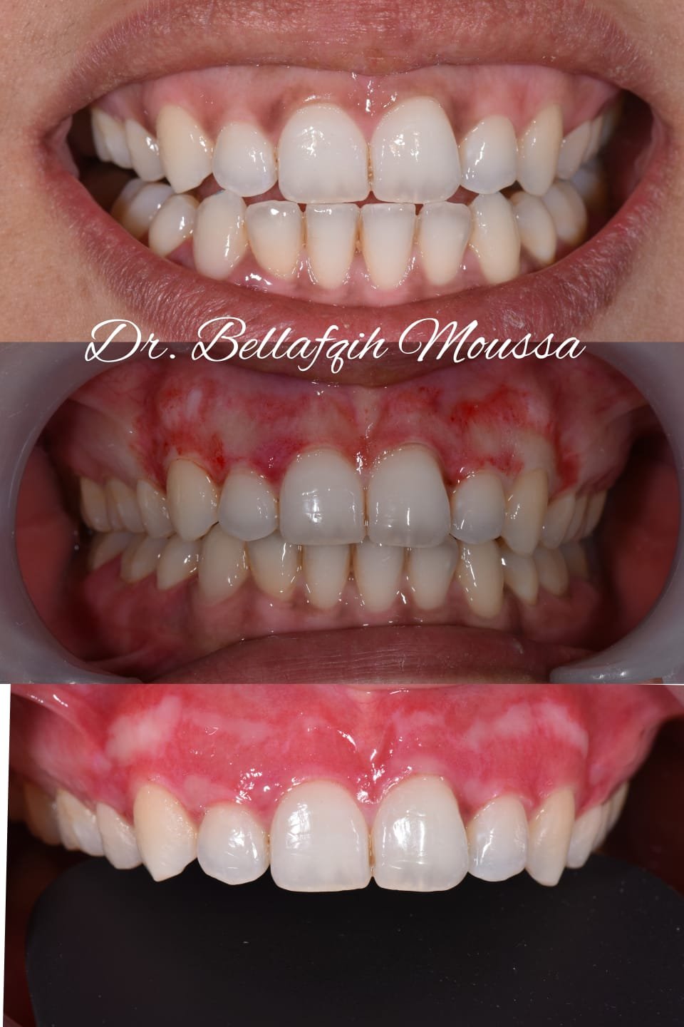Dépigmentation gingivale — cas 3