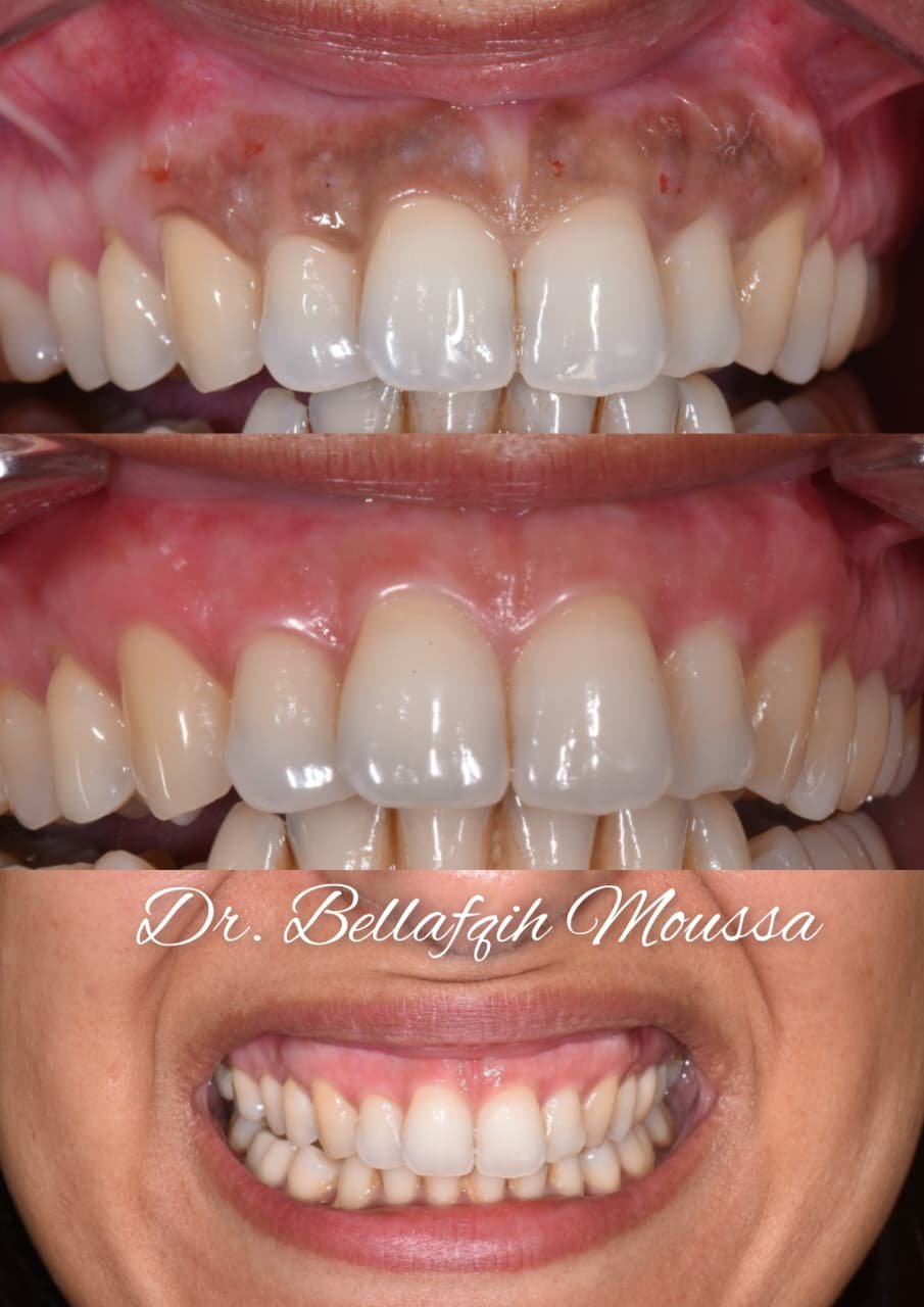 Dépigmentation gingivale — cas 4