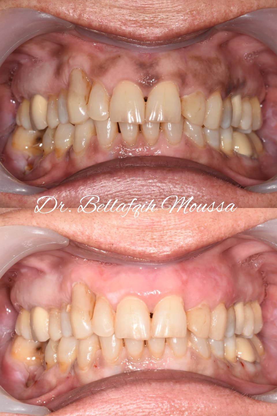 Dépigmentation gingivale — cas 1